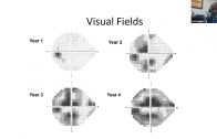 Understanding-glaucoma-patients-Health-disparities-and-unmet-need